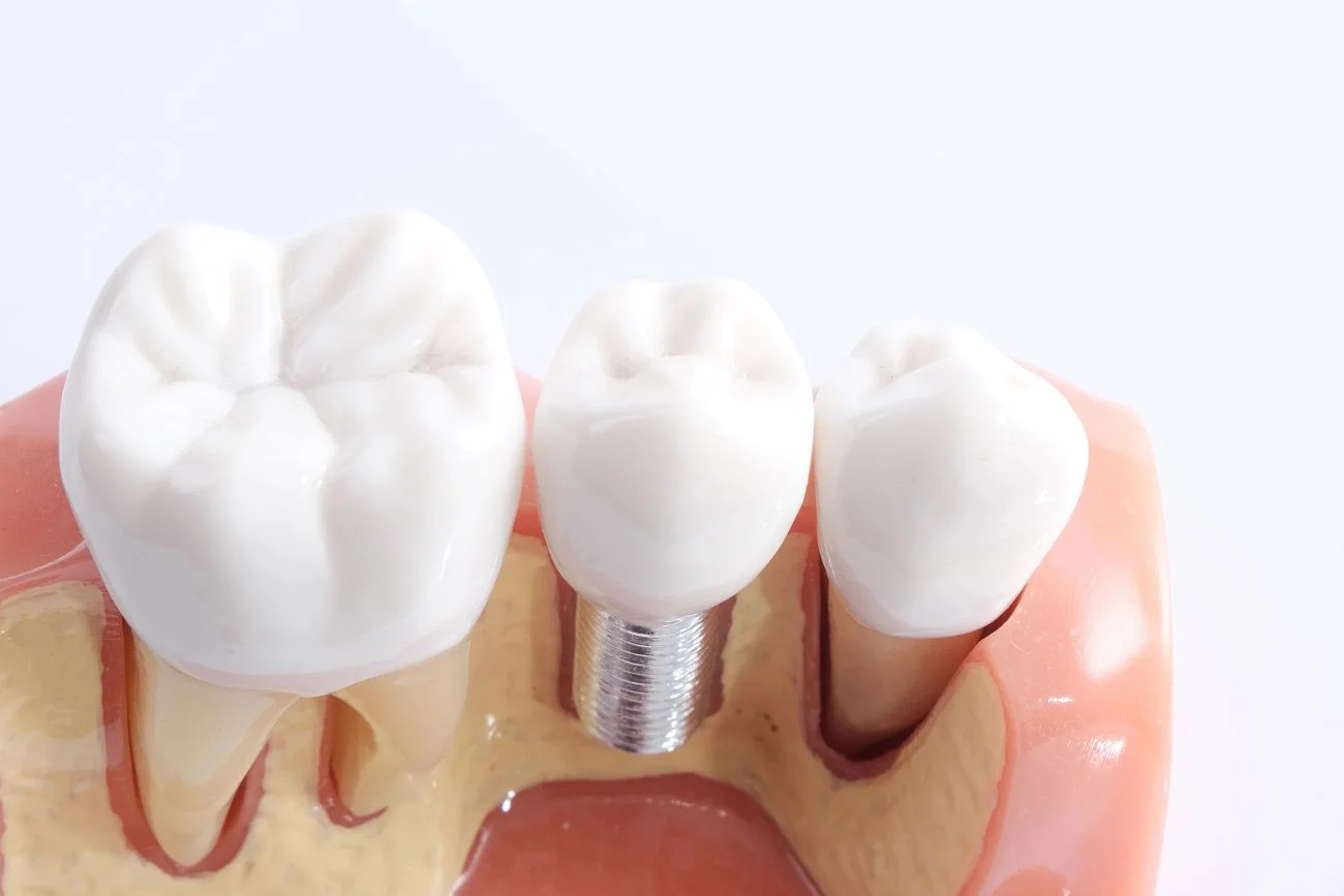 Nowoczesne implanty, które zastąpią naturalne zęby – przewodnik dla pacjenta